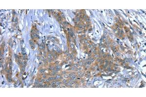 Immunohistochemistry of paraffin-embedded Human cervical cancer using SCPEP1 Polyclonal Antibody at dilution of 1:30 (SCPEP1 抗体)