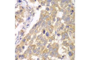 Immunohistochemistry of paraffin-embedded human esophageal cancer using PFKM antibody. (PFKM 抗体  (AA 501-780))