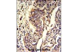Formalin-fixed and paraffin-embedded human lung carcinoma reacted with KYNU Antibody , which was peroxidase-conjugated to the secondary antibody, followed by DAB staining. (KYNU 抗体  (C-Term))