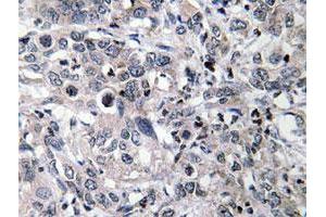 Immunohistochemical analysis of paraffin-embedded human liver carcinoma tissue using CYP2C19 polyclonal antibody . (CYP2C19 抗体)
