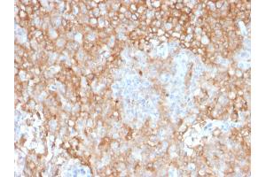Formalin-fixed, paraffin-embedded human Lung Tumor stained with HLA-DR Mouse Monoclonal Antibody (TAL 1B5). (HLA-DR 抗体)