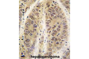 Formalin-fixed and paraffin-embedded human hepatocarcinomareacted with ADK polyclonal antibody , which was peroxidase-conjugated to the secondary antibody, followed by AEC staining. (ADK 抗体  (C-Term))