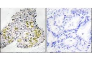 Immunohistochemistry analysis of paraffin-embedded human lung carcinoma tissue, using LKB1 (Ab-428) Antibody. (LKB1 抗体  (AA 384-433))
