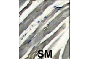 Formalin-fixed and raffin-embedded human hetocarcinoma reacted with RK8 (LRRK2) Antibody  f , which was peroxidase-conjugated to the secondary antibody, followed by DAB staining. (LRRK2 抗体  (AA 878-909))