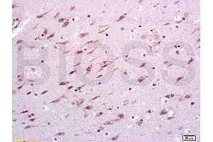 Formalin-fixed and paraffin embedded rabbit brain carcinoma labeled with Anti-VCAM-1/CD106/L1CAM Polyclonal Antibody, Unconjugated (ABIN729838) at 1:300, followed by conjugation to the secondary antibody and DAB staining (VCAM1 抗体  (AA 651-739))