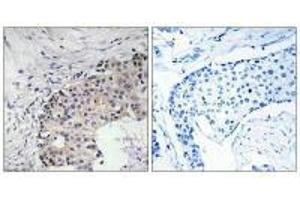 Immunohistochemistry analysis of paraffin-embedded human breast carcinoma tissue using SCARF2 antibody. (SCARF2 抗体)
