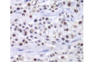 Immunohistochemistry of paraffin-embedded Mouse osteosarcoma using HAT1 Polyclonal Antibody at dilution of 1:200 (40x lens). (HAT1 抗体)