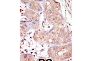 Formalin-fixed and paraffin-embedded human cancer tissue reacted with the primary antibody, which was peroxidase-conjugated to the secondary antibody, followed by DAB staining. (MAK 抗体  (C-Term))
