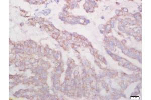 Formalin-fixed and paraffin embedded human lung carcinoma labeled with Rabbit Anti-Biglycan Polyclonal Antibody, Unconjugated (ABIN872817) at 1:200 followed by conjugation to the secondary antibody and DAB staining (Biglycan 抗体  (AA 101-200))