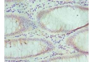 Immunohistochemistry of paraffin-embedded human colon cancer using ABIN7151592 at dilution of 1:100 (TCEB3 抗体  (AA 679-798))