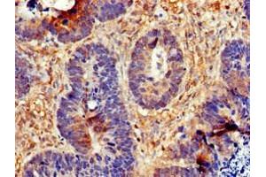 Immunohistochemistry of paraffin-embedded human ovarian cancer using ABIN7147287 at dilution of 1:100 (CDC6 抗体  (AA 1-141))