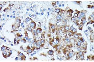 Immunohistochemistry of paraffin-embedded Human liver cancer using PDE3A Polyclonal Antibody at dilution of 1:100 (40x lens). (PDE3A 抗体)