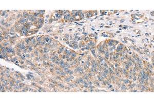 Immunohistochemistry of paraffin-embedded Human ovarian cancer using DECR1 Polyclonal Antibody at dilution of 1:50 (DECR1 抗体)