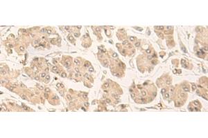 Immunohistochemistry of paraffin-embedded Human gastric cancer tissue using FABP4 Polyclonal Antibody at dilution of 1:60(x200) (FABP4 抗体)