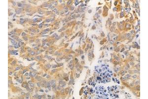 ABIN6263991 and ABIN6269401 at 1/100 staining human lung squamous cell carcinoma by IHC-P.