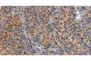 Immunohistochemistry of paraffin-embedded Human liver cancer tissue using MAP3K13 Polyclonal Antibody at dilution 1:40 (MAP3K13 抗体)