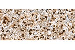 Immunohistochemistry of paraffin-embedded Human liver cancer tissue using MYEF2 Polyclonal Antibody at dilution of 1:70(x200) (MYEF2 抗体)