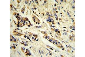 IHC analysis of FFPE human breast carcinoma stained with IL-10 antibody (IL-10 抗体  (AA 27-53))