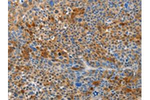 The image on the left is immunohistochemistry of paraffin-embedded Human liver cancer tissue using ABIN7191027(HTRA3 Antibody) at dilution 1/45, on the right is treated with synthetic peptide. (HTRA3 抗体)