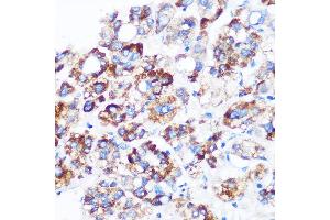 Immunohistochemistry of paraffin-embedded Human liver cancer using C9orf114 Rabbit pAb (ABIN7266390) at dilution of 1:100 (40x lens). (C9orf114 抗体)