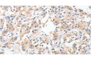 Immunohistochemistry of paraffin-embedded Human thyroid cancer using RPN1 Polyclonal Antibody at dilution of 1:30 (RPN1 抗体)