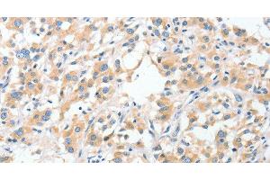 Immunohistochemistry of paraffin-embedded Human thyroid cancer using RPN1 Polyclonal Antibody at dilution of 1:30 (RPN1 抗体)