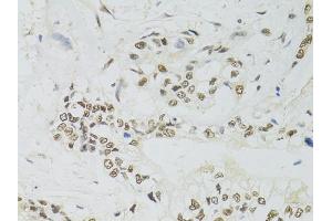 Immunohistochemistry of paraffin-embedded human gastric cancer using PPP4C antibody (ABIN5971135) at dilution of 1/100 (40x lens). (PPP4C 抗体)