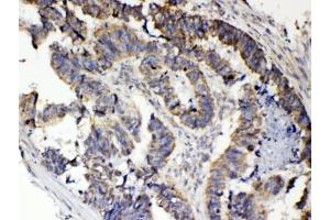 IHC testing of FFPE human intestinal cancer tissue with RANK antibody at 1ug/ml. (TNFRSF11A 抗体  (AA 235-262))