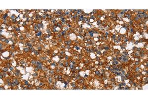 Immunohistochemistry of paraffin-embedded Human thyroid cancer tissue using COX5A Polyclonal Antibody at dilution 1:40 (COX5A 抗体)