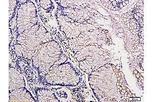 Formalin-fixed and paraffin embedded: human colon tubular adenocarcinoma labeled with Anti-PDGF-A Polyclonal Antibody (ABIN726155), Unconjugated at 1:300, followed by conjugation to the secondary antibody and DAB staining (PDGFA 抗体  (AA 125-170))