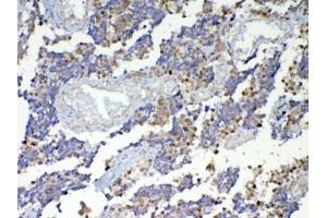 IHC testing of FFPE human lung cancer tissue with Dnmt1 antibody at 1ug/ml. (DNMT1 抗体)