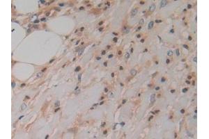 Detection of PK2 in Human Skin cancer Tissue using Polyclonal Antibody to Prokineticin 2 (PK2)
