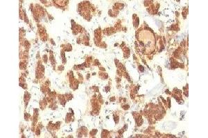 Formalin-fixed, paraffin-embedded human thyroid carcinoma stained with Cytokeratin 18 antibody. (Cytokeratin 18 抗体)
