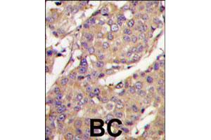 Formalin-fixed and paraffin-embedded human breast carcinoma tissue reacted with UBE2L6 polyclonal antibody  , which was peroxidase-conjugated to the secondary antibody, followed by DAB staining. (UBE2L6 抗体  (C-Term))