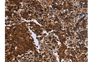 The image on the left is immunohistochemistry of paraffin-embedded Human liver cancer tissue using ABIN7190664(FMN2 Antibody) at dilution 1/30, on the right is treated with synthetic peptide. (Formin 2 抗体)