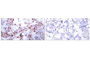 Immunohistochemical analysis of paraffin-embedded human breast carcinoma tissue using ATF-2 (Ab-62 or 44) antibody (E021029). (ATF2 抗体)