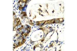 Immunohistochemistry of paraffin-embedded human gastric cancer using SNCA antibody at dilution of 1:100 (x40 lens). (SNCA 抗体)