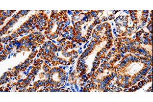 Immunohistochemistry of paraffin-embedded Human thyroid cancer tissue using COX19 Polyclonal Antibody at dilution 1:50 (COX19 抗体)