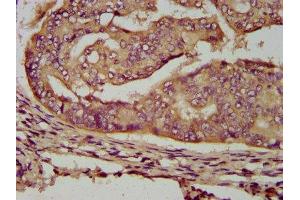 IHC image of ABIN7159857 diluted at 1:200 and staining in paraffin-embedded human endometrial cancer performed on a Leica BondTM system. (ENOSF1 抗体  (AA 171-286))