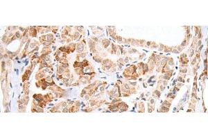 Immunohistochemistry of paraffin-embedded Human thyroid cancer tissue using HOXC11 Polyclonal Antibody at dilution of 1:25(x200) (HOXC11 抗体)