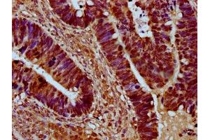 IHC image of ABIN7168962 diluted at 1:500 and staining in paraffin-embedded human ovarian cancer performed on a Leica BondTM system. (SRRM4 抗体  (AA 400-479))