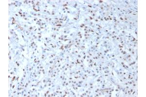 Formalin-fixed, paraffin-embedded human Mesothelioma stained with Wilm's Tumor Mouse Monoclonal Antibody (WT1/857). (WT1 抗体)