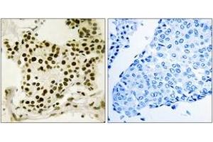 Immunohistochemistry analysis of paraffin-embedded human breast carcinoma, using UBF (Phospho-Ser484) Antibody. (UBTF 抗体  (pSer484))