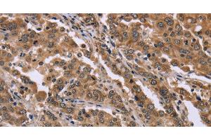 Immunohistochemistry of paraffin-embedded Human liver cancer tissue using FAM3B Polyclonal Antibody at dilution 1:40 (FAM3B 抗体)