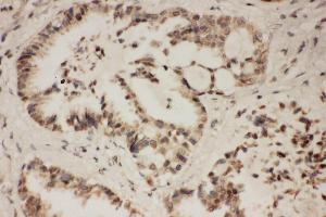 Anti-FGFR1 antibody, IHC(P) IHC(P): Human Lung Cancer Tissue (FGFR1 抗体  (C-Term))
