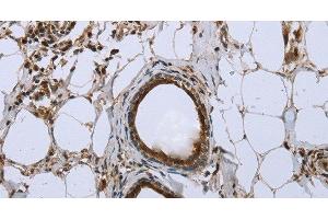 Immunohistochemistry of paraffin-embedded Human breast cancer using FBP1 Polyclonal Antibody at dilution of 1:40 (FBP1 抗体)