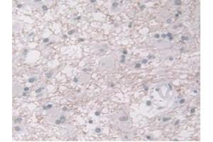 DAB staining on IHC-P;Samples:Human Glioma Tissue) (ORM1 抗体  (AA 19-201))