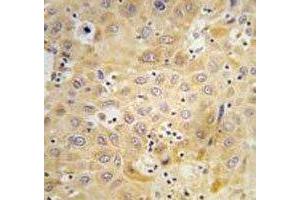 IHC analysis of FFPE human hepatocarcinoma tissue stained with ATG7 antibody (ATG7 抗体  (AA 22-51))