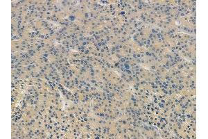 ABIN7094177 and ABIN7098222 at 1/100 staining human hepatocellular carcinoma by IHC-P. (DNM2 抗体  (C-Term))
