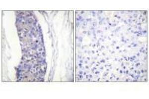 Immunohistochemistry analysis of paraffin-embedded human breast carcinoma tissue using Tubulin α antibody. (TUBA1A 抗体  (C-Term))